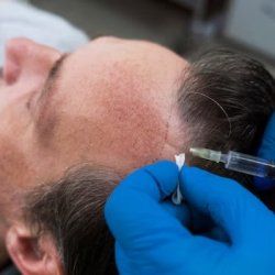 Best Hair Transplant in Bangalore | Hair Transplant Clinic